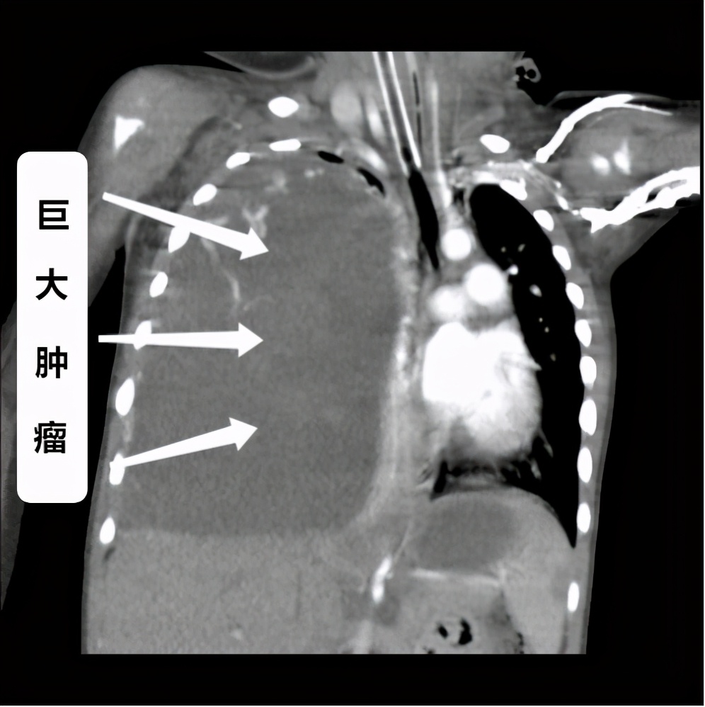 5岁女童患病罕见肿瘤,1岁女童被确诊癌症晚期