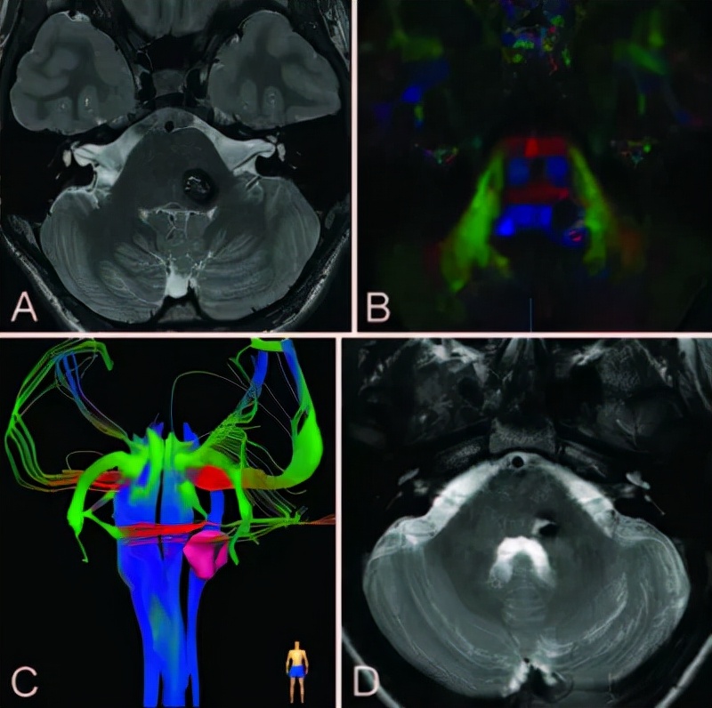 良性脑瘤一般能活多久,良性脑瘤没切干净要化疗