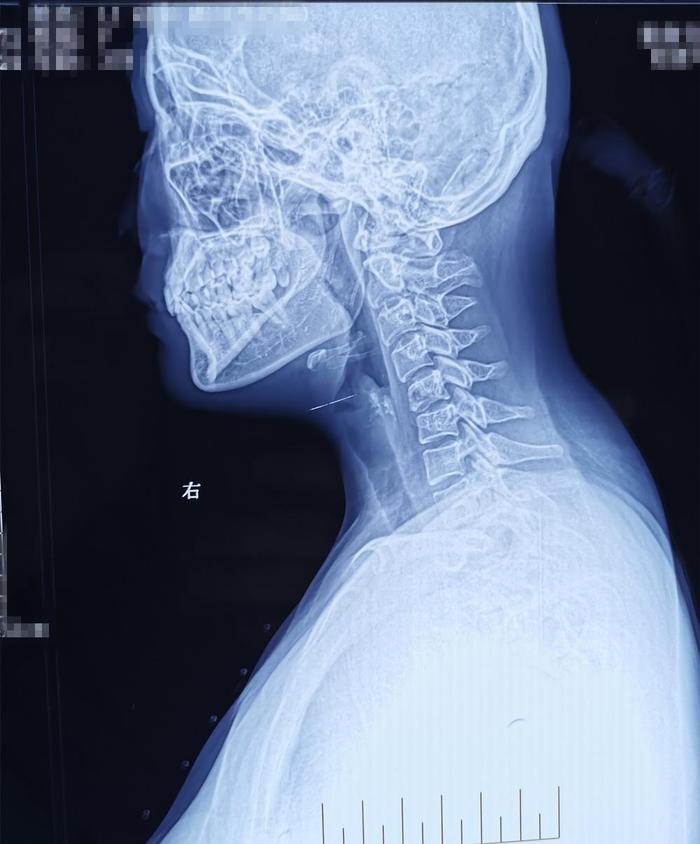 因颈背部疼痛、上臂抽疼，检查出颈5椎体结核