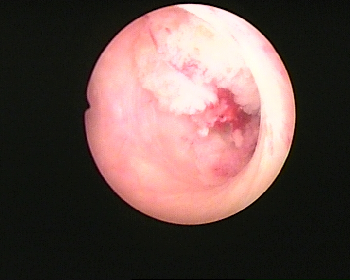 产后月经复潮量比较多正常吗,产后月经复潮的症状