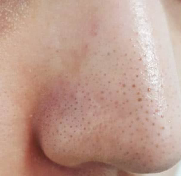 鼻子挤出黄米粒怎么解决,鼻子上有小洞能挤出很多东西