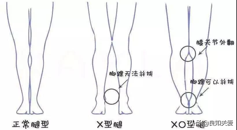 怎样练股四头肌保护膝关节,史冬泉医生如何保护膝关节