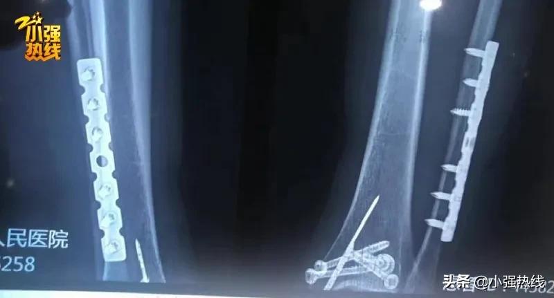 女子旅游崴脚骨折索赔18w,女子扭伤脚踝拆钢板赔偿