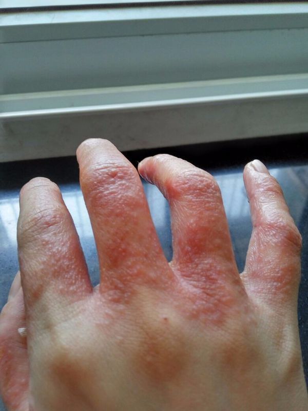 汗疱疹怎样快速止痒有什么偏方吗,一年四季起汗疱疹最有效的偏方