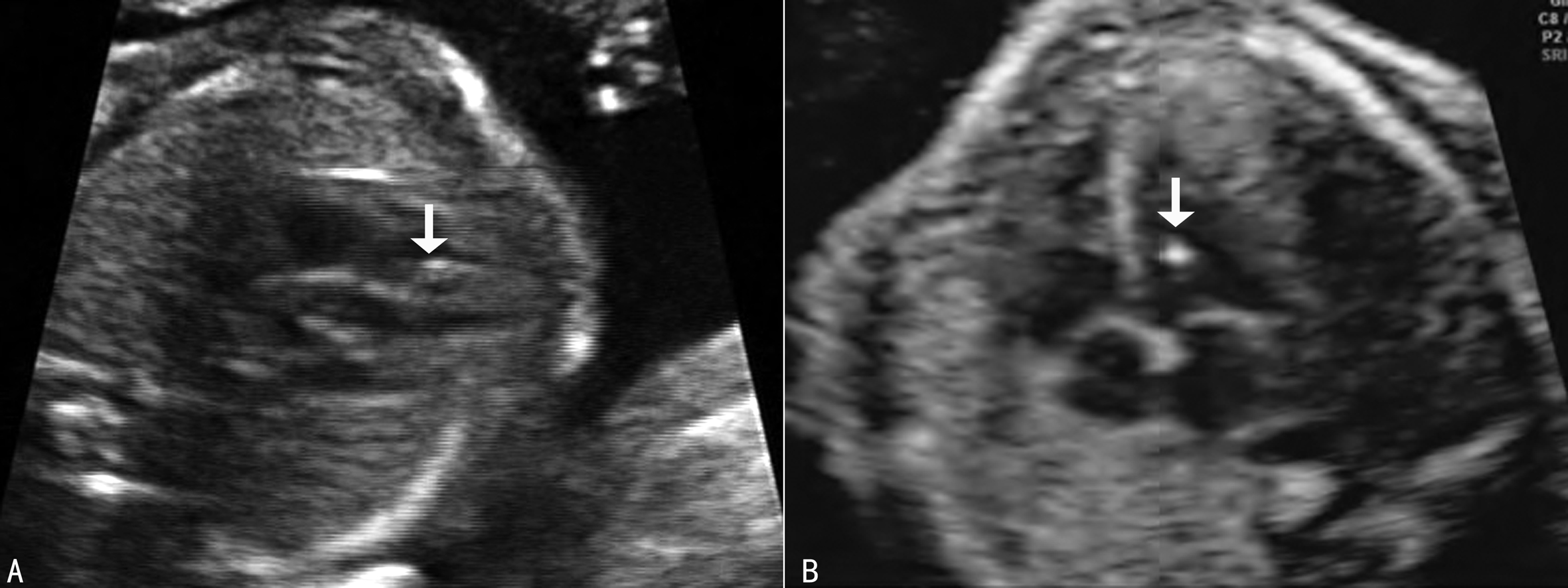 孕晚期胎儿染色体检查与基因检查,孕中期染色体异常超声指标