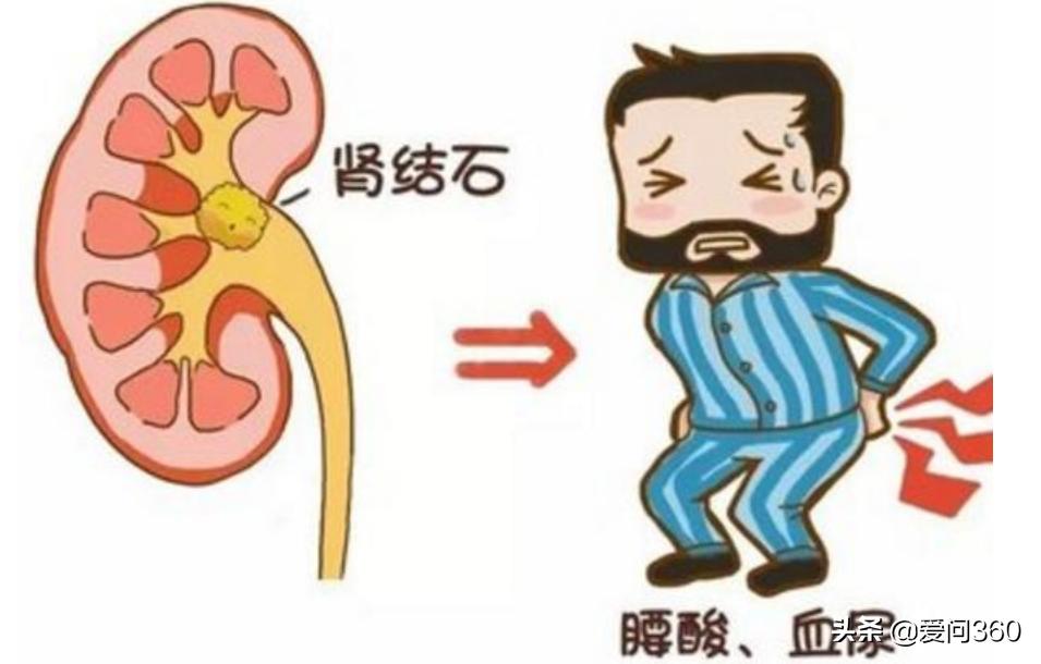 肾结石通常是什么原因造成的,肾结石是怎么形成的有什么方法