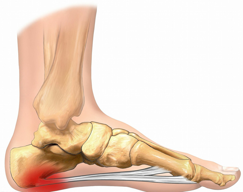 脚踩地雷的正确手法,脚踩地雷紧急措施