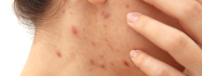 不想*疮痤**变月球表面，那这篇文章就是你需要的