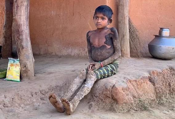 女孩离奇变石头人，印度专家一脸懵，中医鱼鳞病专家却这样说