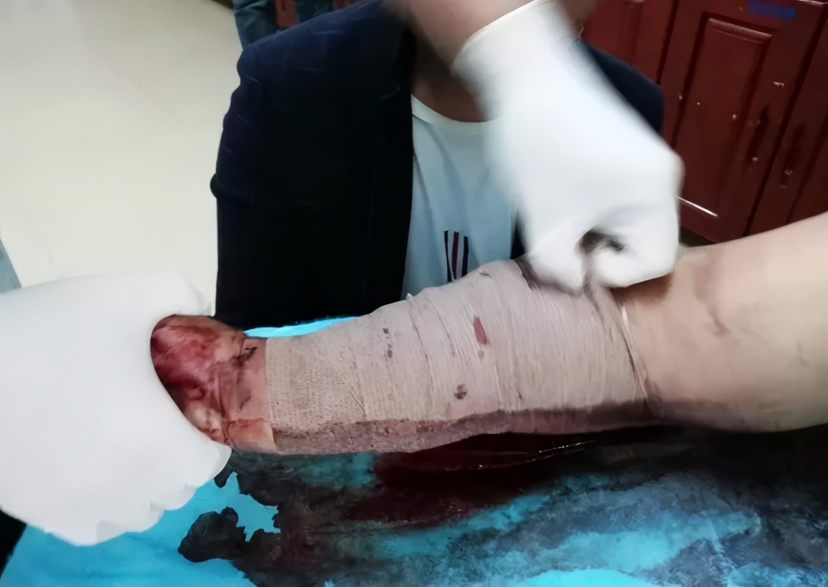 家人用皮筋包扎伤口结果导致截肢,截肢患者弹力绷带包扎法