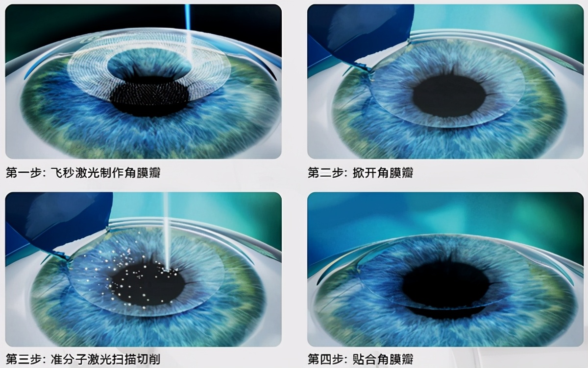 高考激光近视手术,高考参军近视眼要提前多久做手术