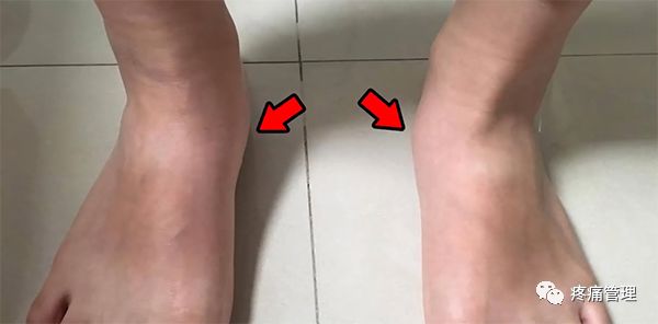 专门改善扁平足的运动,站着改善小腿外翻
