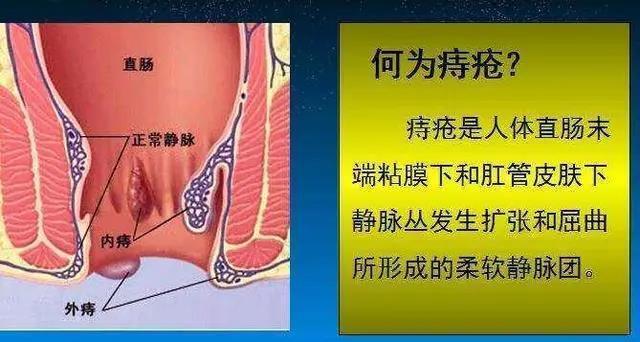 痔疮不治疗会自己自愈吗,痔疮脱出3cm一般多久可以自愈