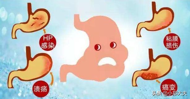慢性胃炎为什么反反复复总不好,慢性胃炎一直不好是什么原因