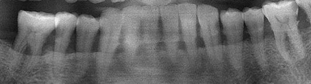 喷砂洗牙到底好不好,洗牙到底对牙齿好不好