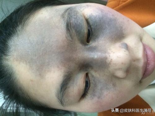 脸上有斑是做冷冻还是激光,黄褐斑用激光祛好还是吃中药