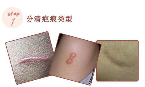 皮肤祛疤痕最有效方法,皮肤上有疤怎样祛疤