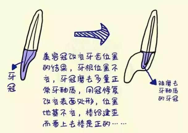 前牙磕掉了一块怎么办？#葉子口腔科普#