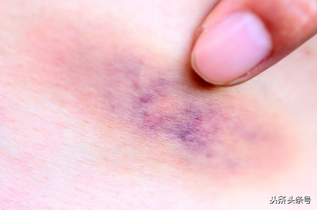 我摔得青紫一片，他说是牛仔裤褪色，这样的男人还能要吗？