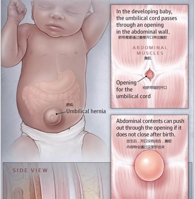 宝宝肚脐眼鼓用硬币怎么弄,宝宝肚脐眼鼓出来了怎么放硬币