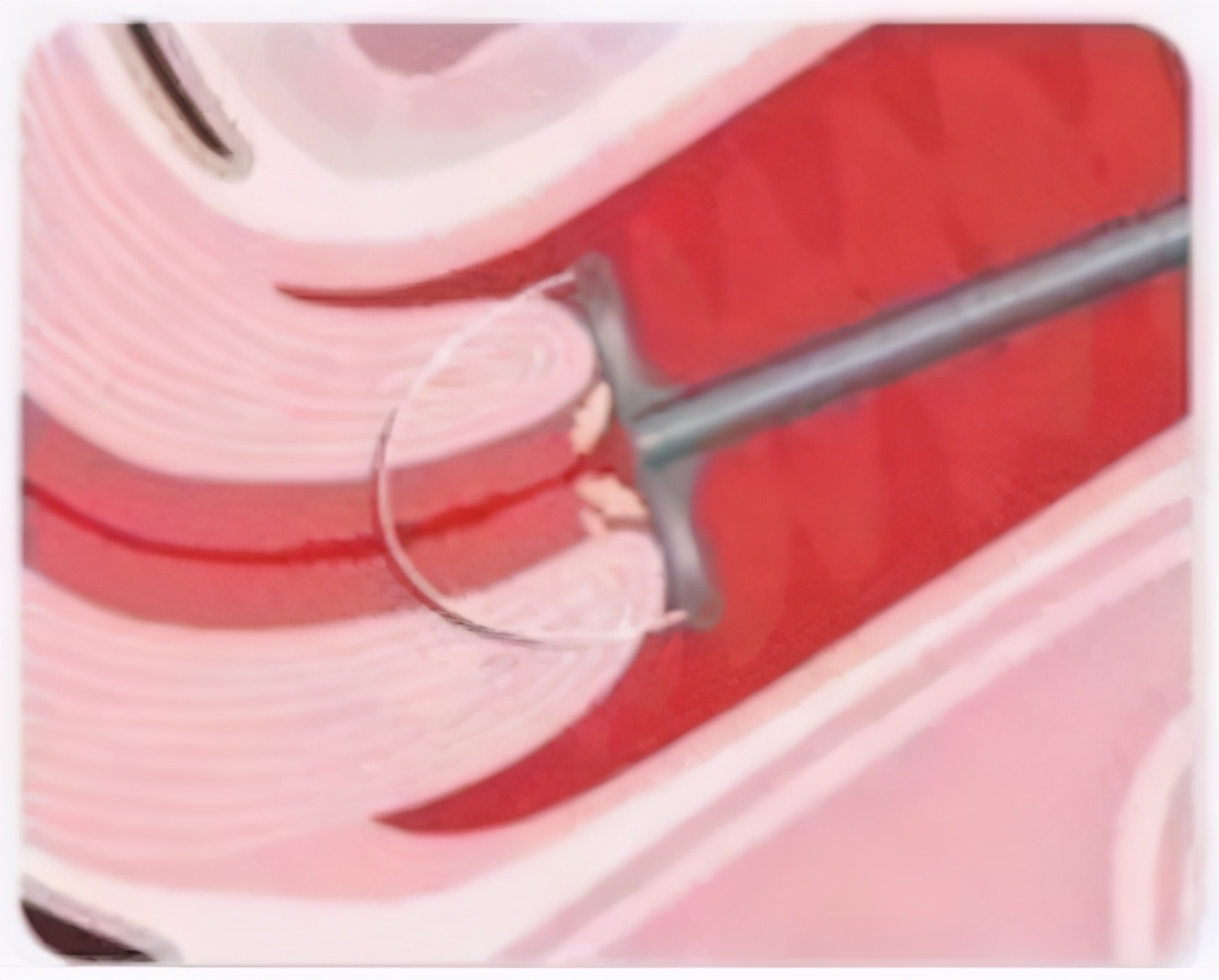 做了leep刀能正常怀孕生子吗,leep术后影响生孩子吗