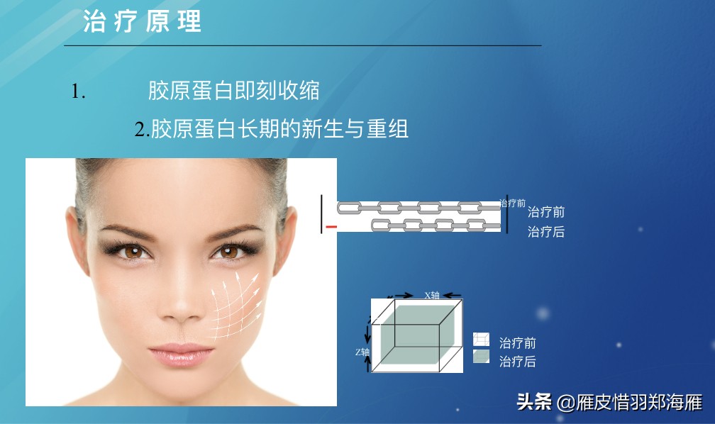 黄金微针眼部抗衰,黄金微针抗衰老的效果自然吗