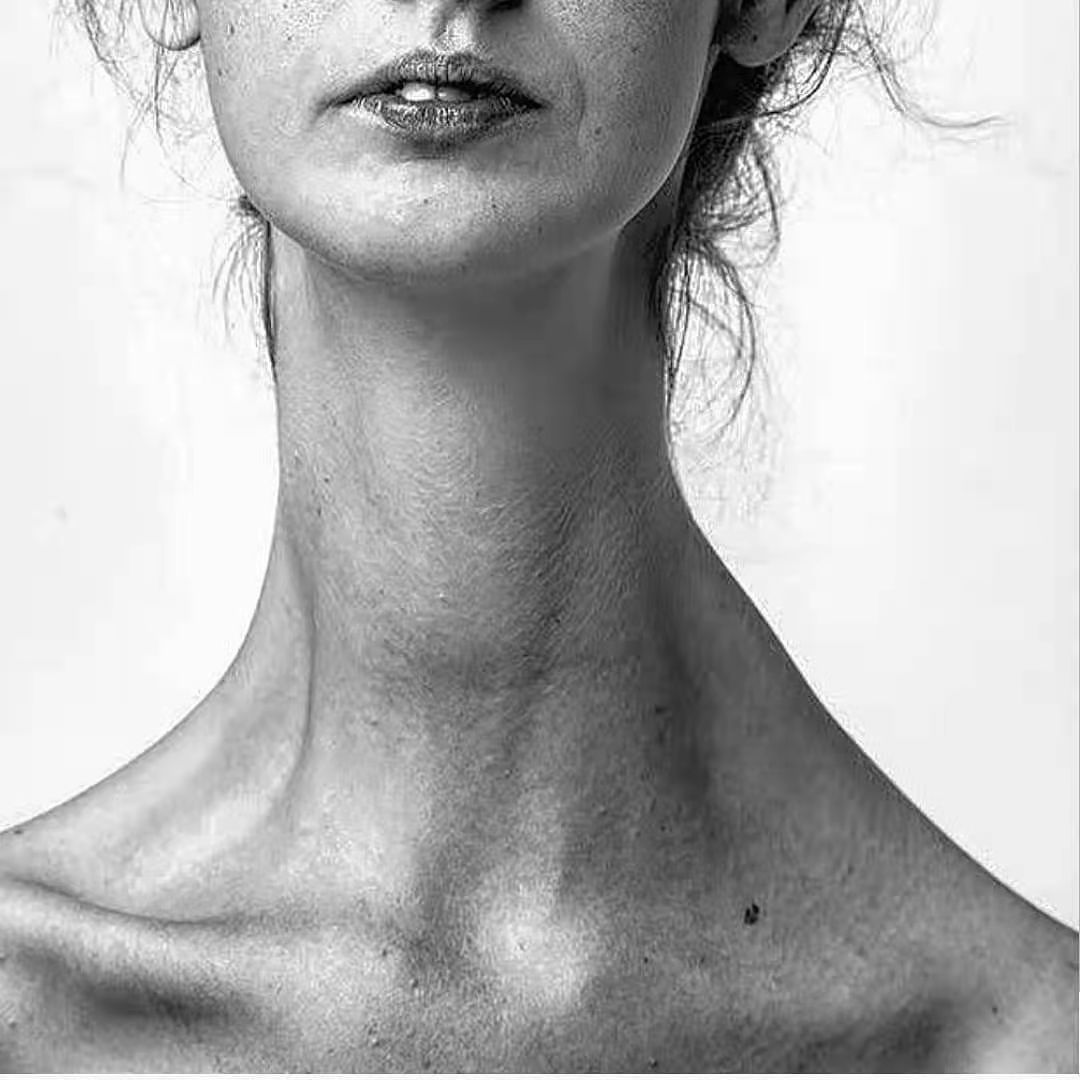 女孩得“肢体细长症”脖子18厘米长，从自卑抑郁变成自信仙女