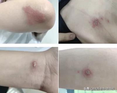 被毒隐翅虫咬怎么治疗,中了隐翅虫毒有什么感觉