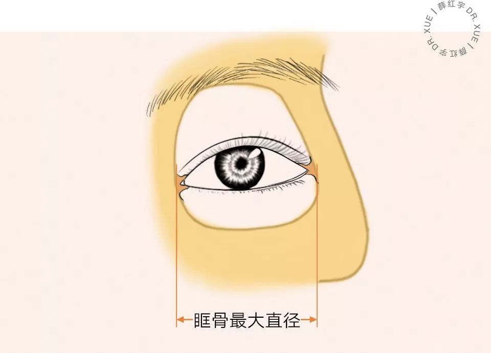 要不要开下眼睑,要不要开内眦赘皮