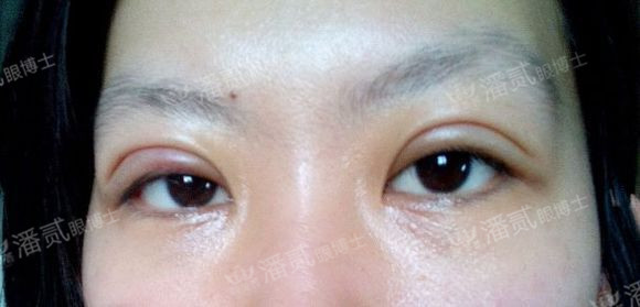 原来双眼皮不好看有必要继续割吗,割双眼皮是不是越修复越难看