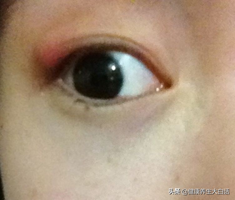 解决麦粒肿,生活小妙招麦粒肿