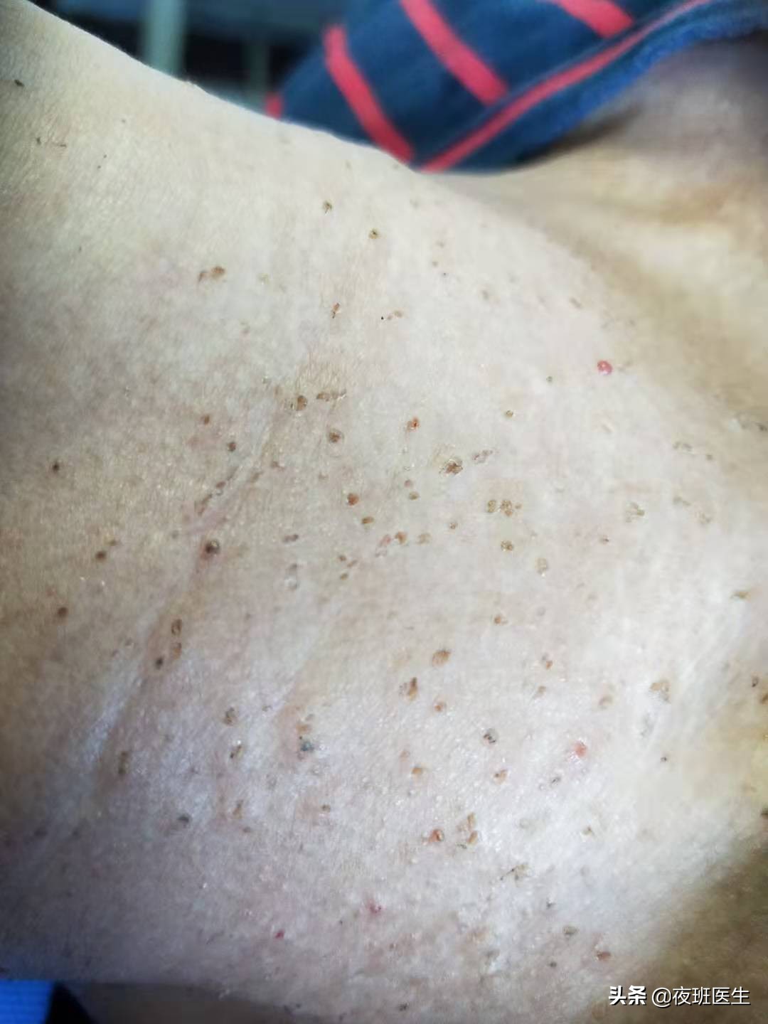 脖子和身上长了褐色的小点点凸起,脖子和背上有红色的斑块