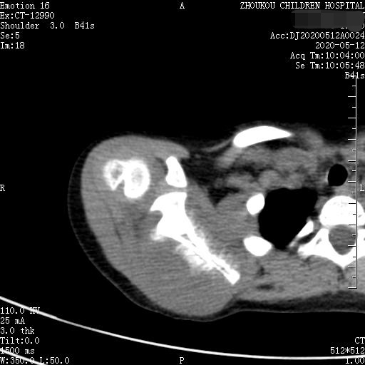 家长要警惕孩子腺样体面容,家长应该警惕孩子出现异常