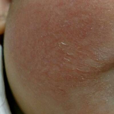 孩子皮肤摸着干燥麻麻的,孩子皮肤缺水干燥起皮