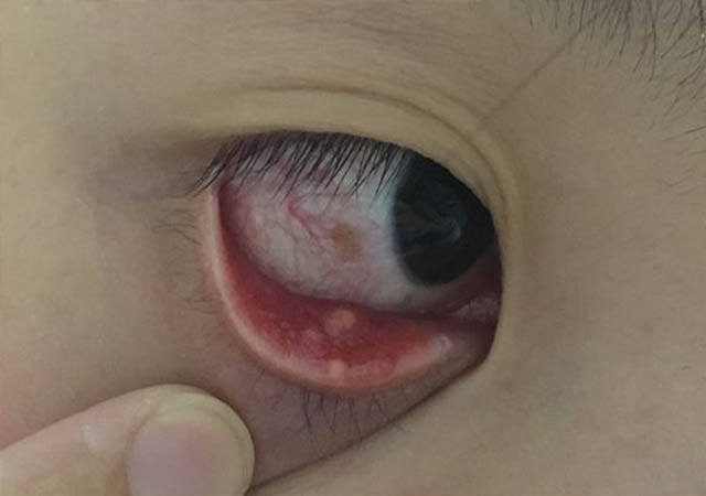 小姐姐熬夜长痘出血,常年熬夜皮肤暗沉长青春痘怎么办