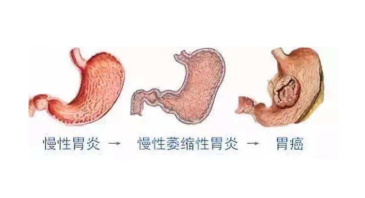 萎缩性胃炎伴肠上皮化生怎么回事,胃镜是萎缩性胃炎伴肠化生要紧吗