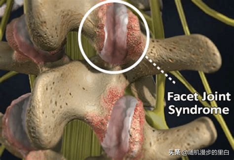 游泳完腰疼是什么原因,游泳时候腰痛