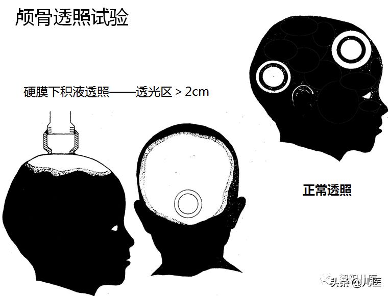 要是不打疫苗有事吗,不打疫苗对住院有影响么