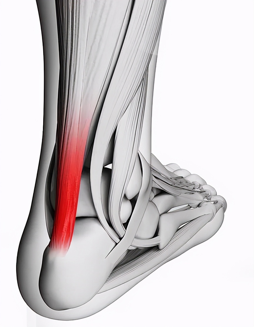 跟腱自发性断裂,跟腱断裂全负重行走