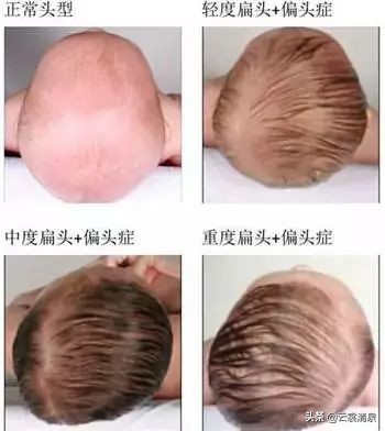 宝宝扁头怎么矫正圆头,宝宝头型怎么从扁头到圆头