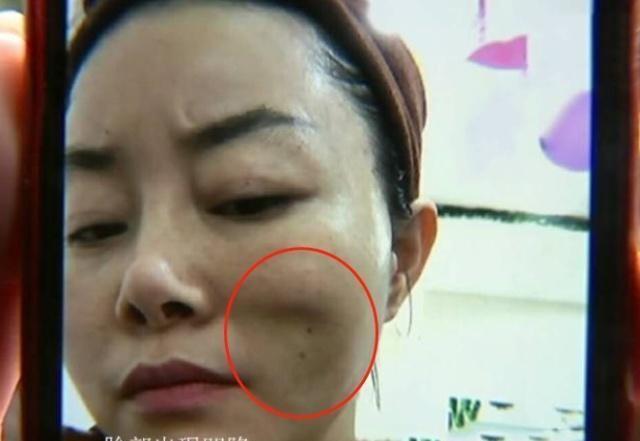 美容针美容的误区,为美而整容最后付出的代价