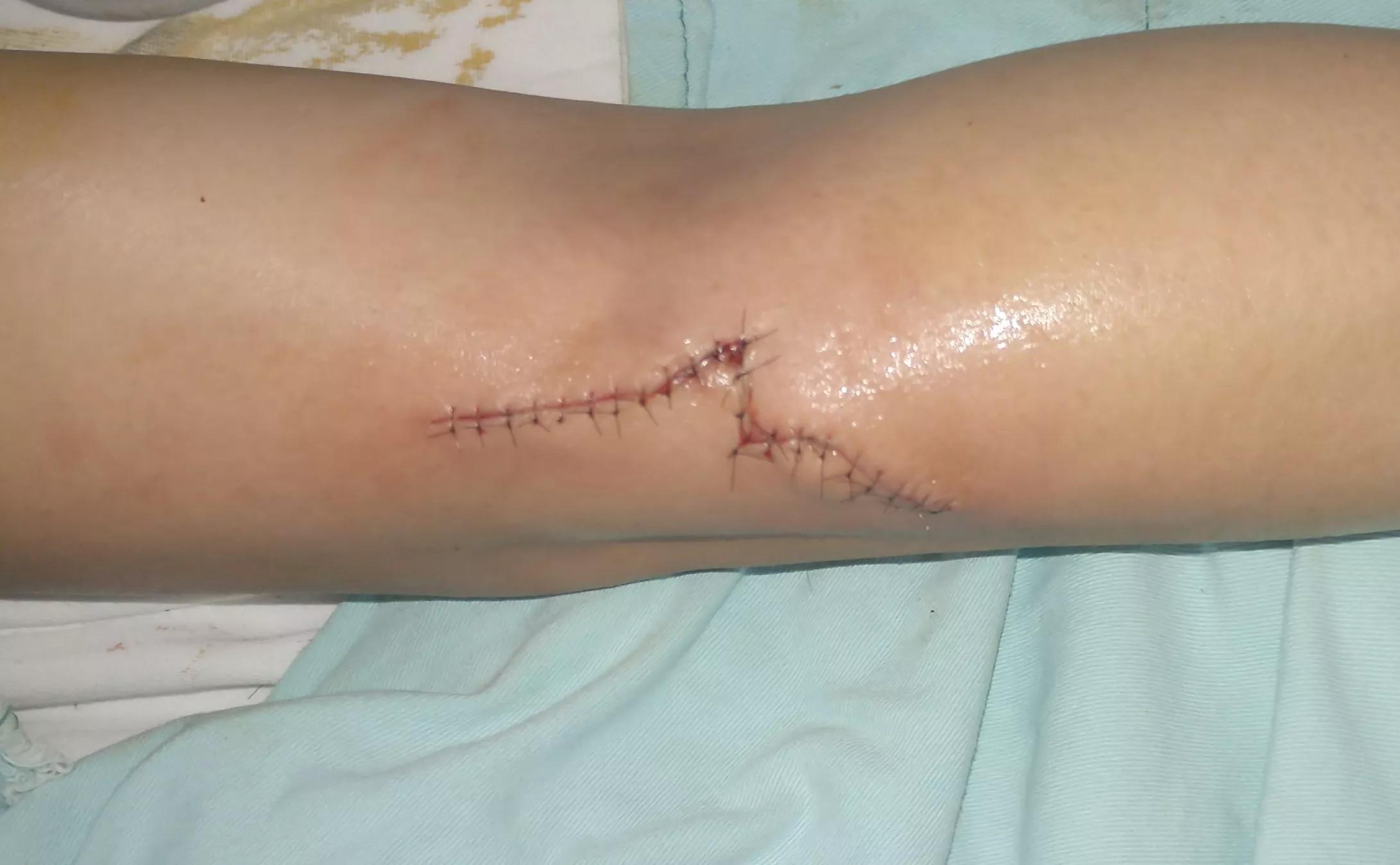 各种皮肤缝合伤口的方法对比