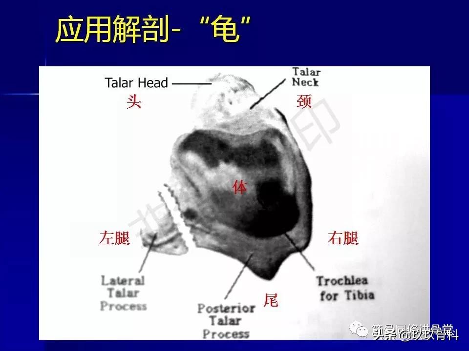 距骨骨折的治疗原则,距骨骨折如何调理