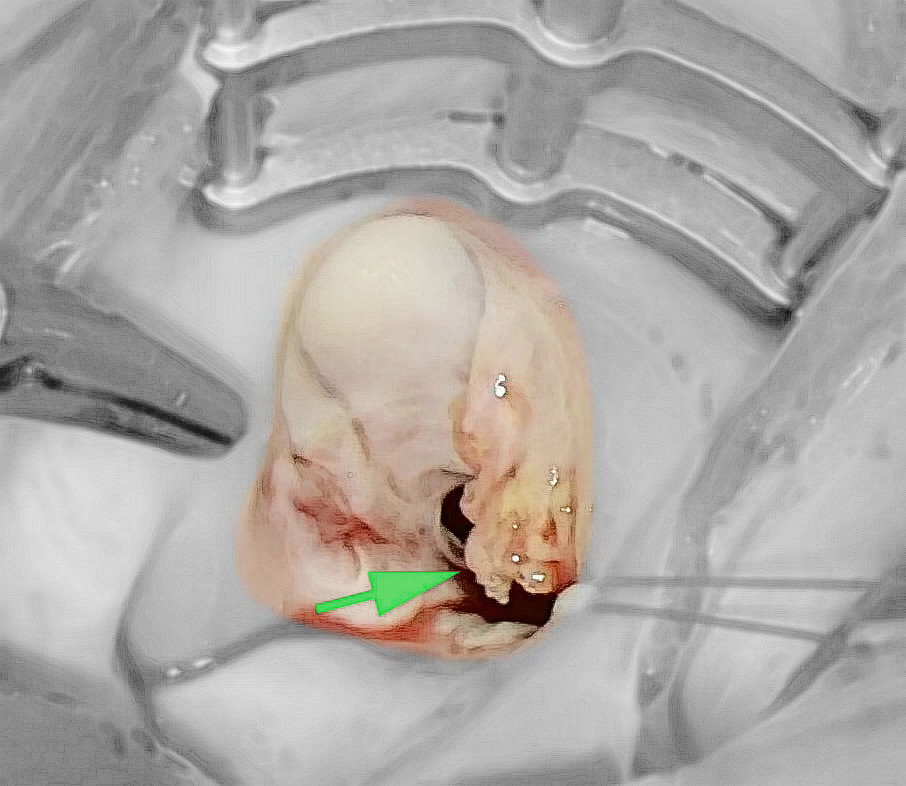 感染性心内膜炎不发热的原因,18岁女孩身上发热是怎么回事