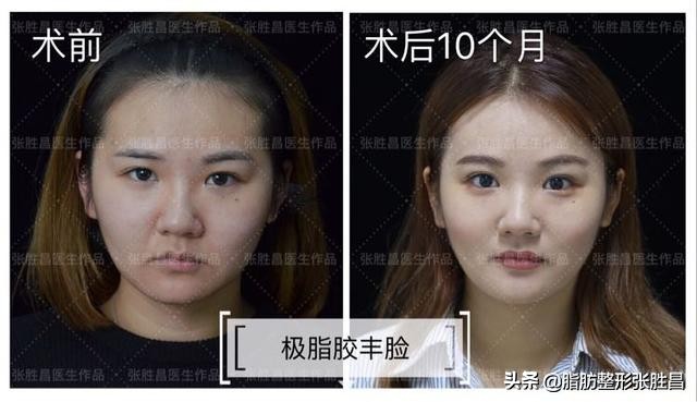 极脂胶丰额角太阳穴下巴｜22岁的自己竟比18岁的要漂亮多了