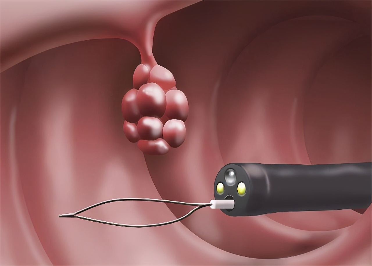 做胃镜发现有息肉建议切除吗,做胃镜发现息肉可以直接切除吗