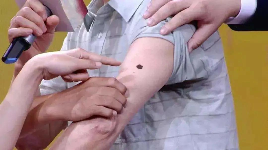 哪些黑痣容易恶变?需要切除吗?