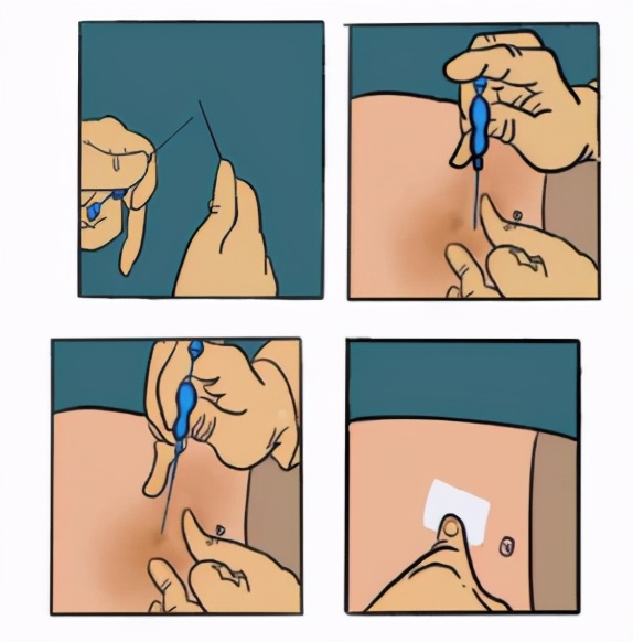 中医治疗复发性流产的优势——下篇