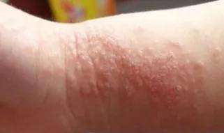 艾滋病窗口期皮肤瘙痒挠了会怎样,浑身皮肤瘙痒越挠越痒怎么解决