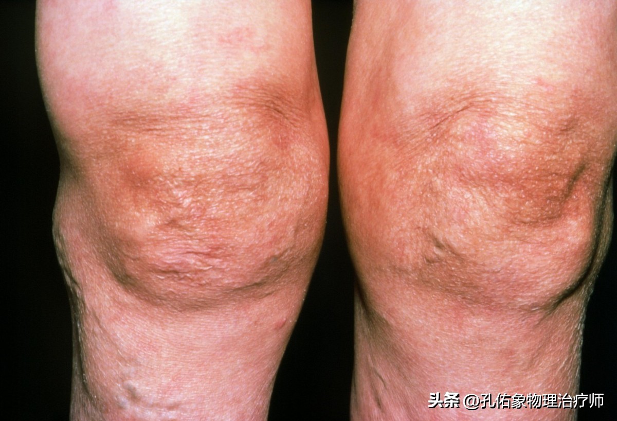 膝疼的最佳治疗方法,如何克服膝痛